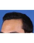 After Hair Transplant&nbsp;Front